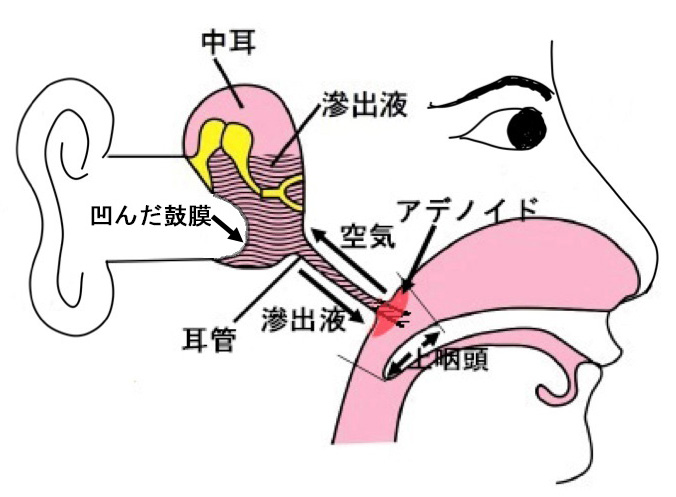 滲出性中耳炎 大泉学園耳鼻咽喉科