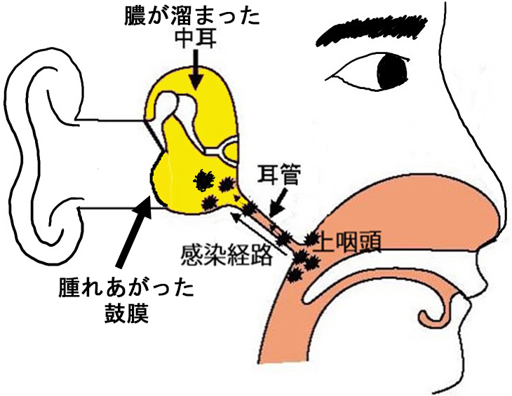 急性中耳炎 大泉学園耳鼻咽喉科