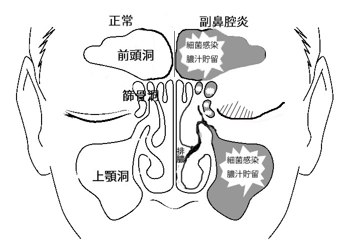 炎 副 鼻腔 副鼻腔炎を繰り返す原因はストレスや疲れ？カビ菌やたばこも注意？